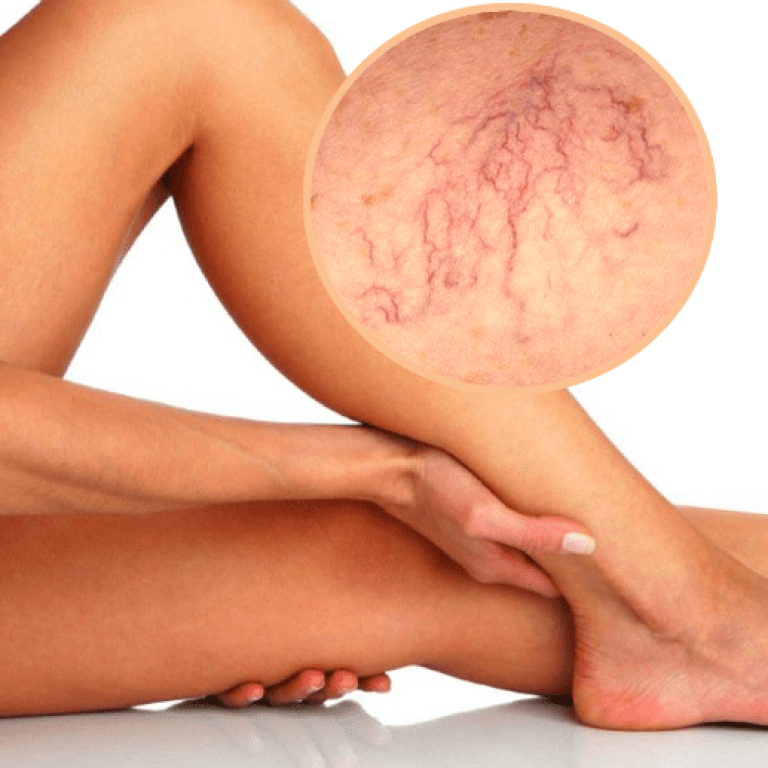 Arañas-Vasculares-min